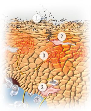Ilustración de la piel con síntomas de la dermatitis atópica