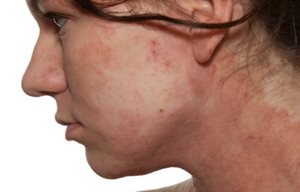 Mujer de perfil con piel enrojecida en la zona del cuello, la barbilla y las mejillas.